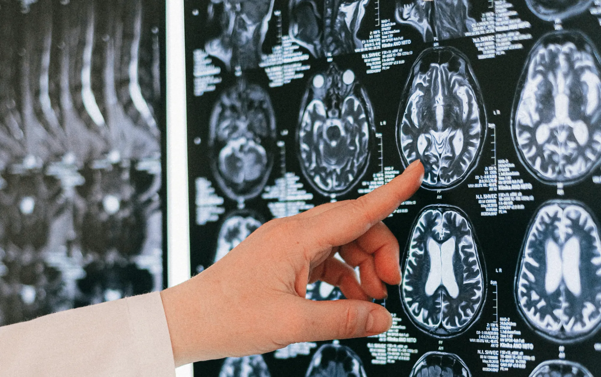 Магнитно-резонансна томография